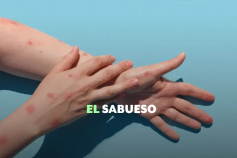 Brote de Sarampión en México: Casos Superan los 9,400 y Expertos Alertan sobre Contagio