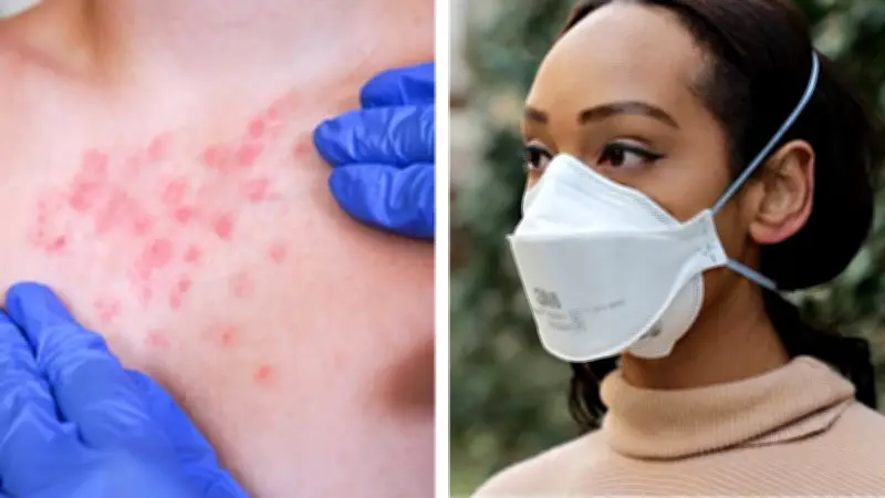 Brote de Sarampión: Estados Recomiendan Cubrebocas, pero Expertos Cuestionan su Eficacia