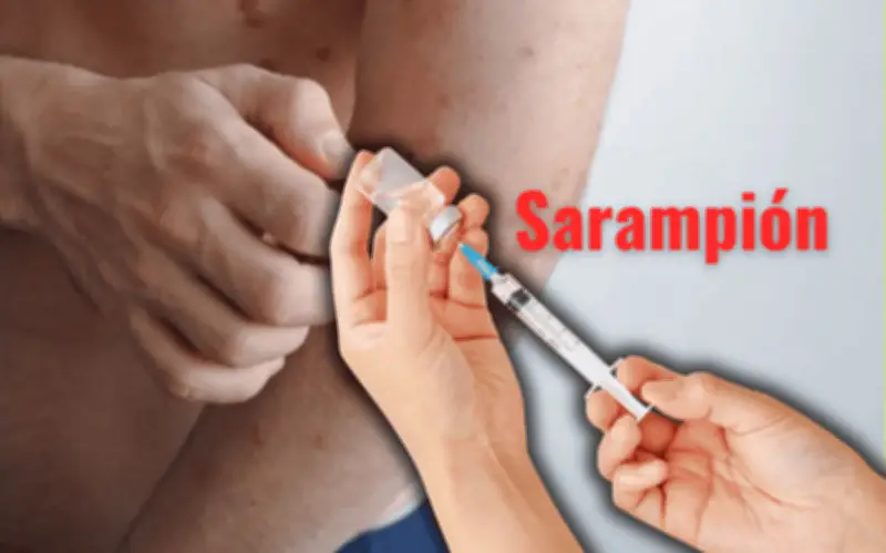 Brote de Sarampión en México: Causas y Urgencia de Vacunación