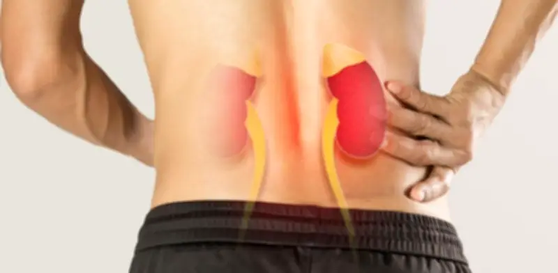 Cólico Renal: Cómo Identificarlo, Tratarlo y Prevenirlo Eficazmente