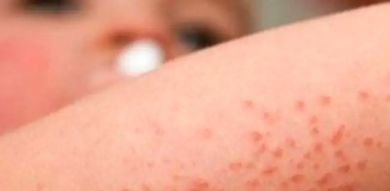 Cofepris aprueba terapia biológica Dupilumab para dermatitis atópica grave