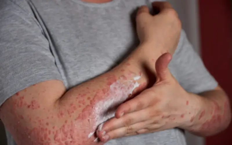 Cuidados esenciales para pacientes con sarampión: aislamiento y reposo