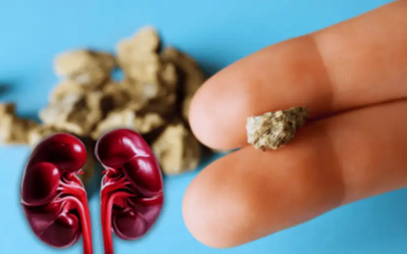 Cálculos renales: 5 síntomas de alarma que no debes ignorar