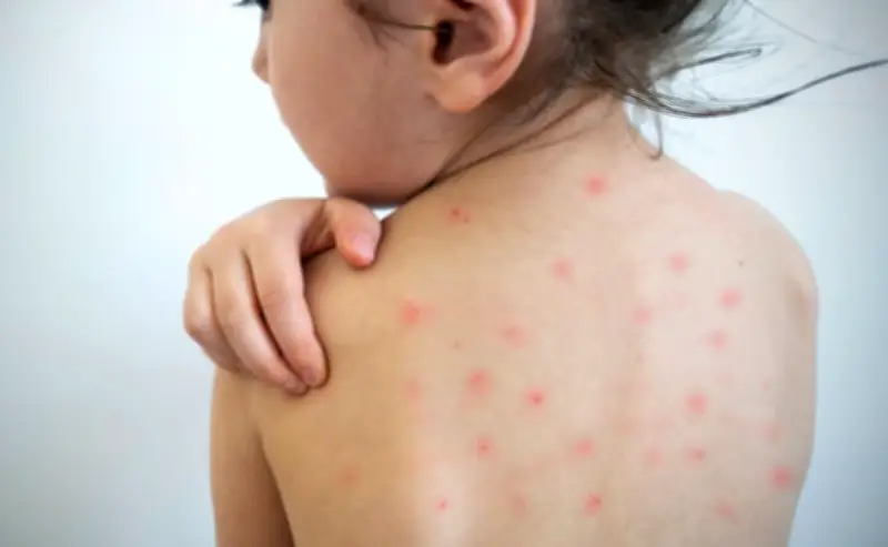 Durango registra primera muerte por sarampión en menor de 8 años; casos aumentan a 22 en 2026