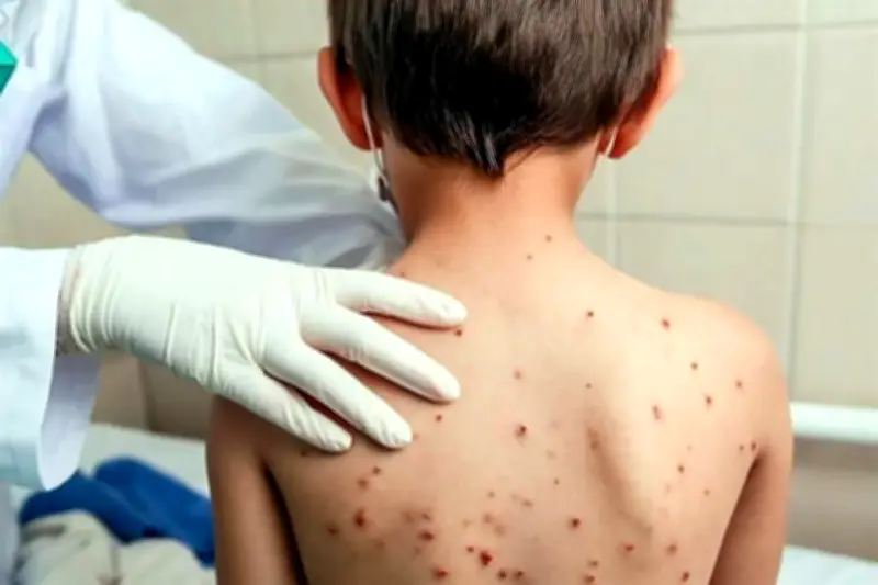 Exigen penalizar a funcionarios por muertes por sarampión en México