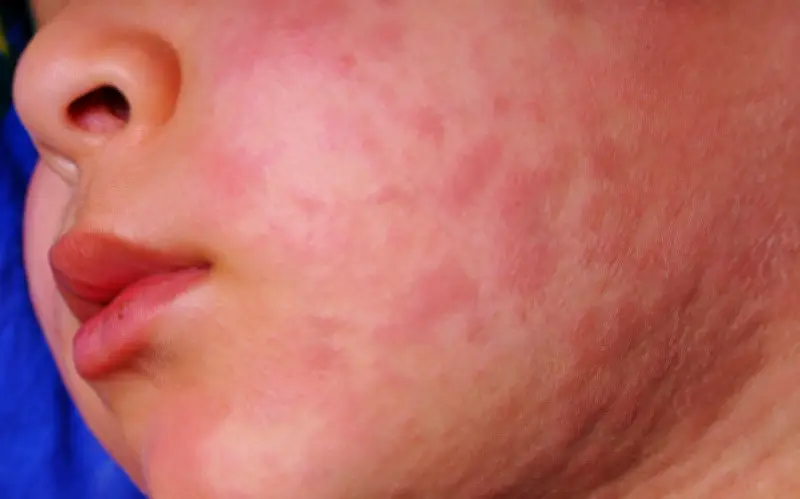 Hidalgo Activa Medidas Sanitarias por Brote de Sarampión en Tres Municipios