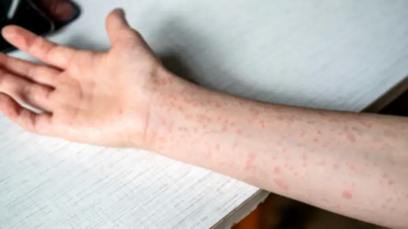 Investigan posible segunda muerte por sarampión en CDMX; reportan 263 contagios