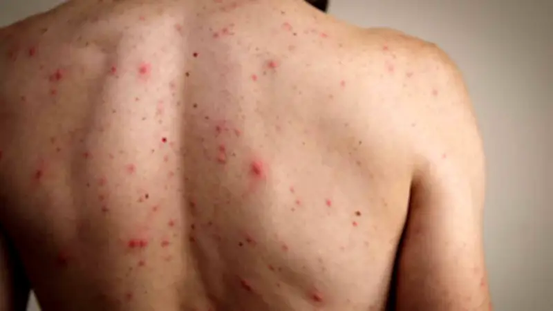 Mayores de 50 años no requieren vacuna contra sarampión por inmunidad natural adquirida