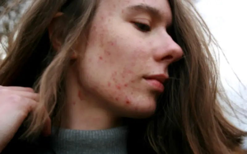 Multivitamínicos y Acné: ¿Qué Vitaminas Causan Brotes en la Piel?