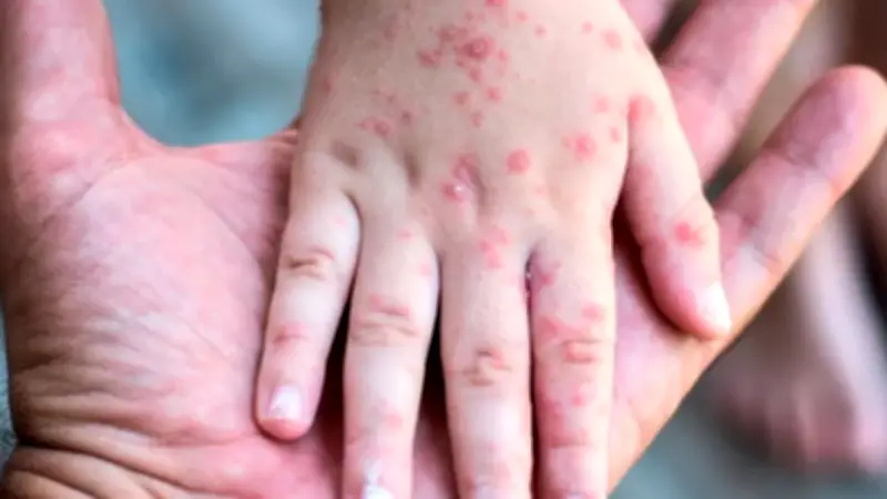 Primera víctima mortal de sarampión en CDMX fue una bebé; alcaldías con más casos