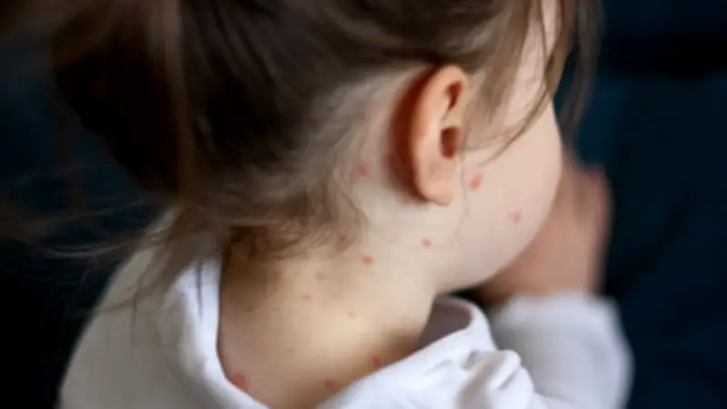 Sarampión en BCS: Activado cerco sanitario tras primer caso en niña de Cabo San Lucas