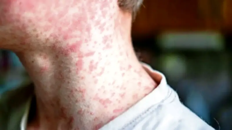 Sarampión en CDMX: Primer fallecimiento y casi 9 mil casos confirmados en México