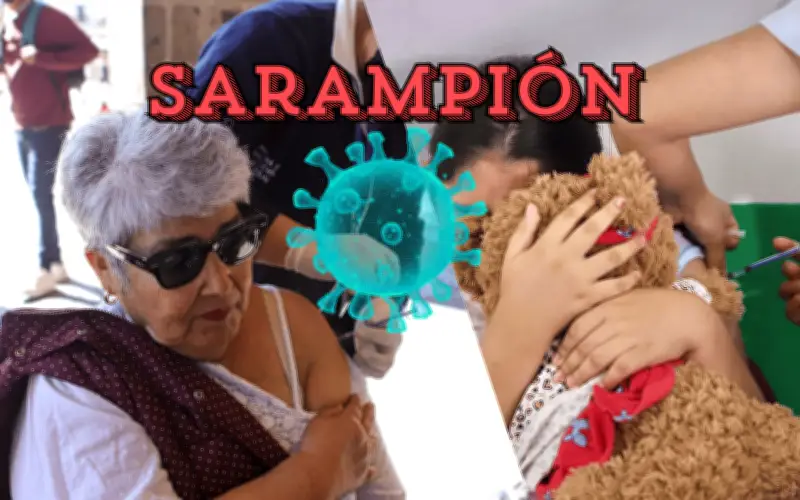 Sarampión en Jalisco: Diferencias Clave en Síntomas entre Adultos y Niños