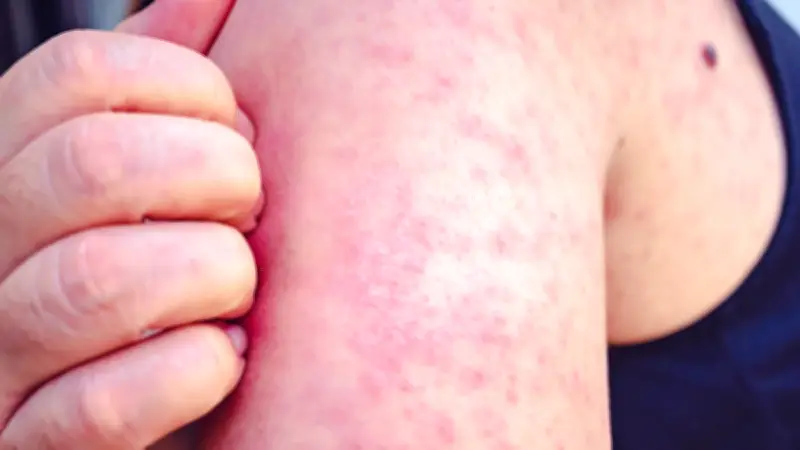 Sarampión en México: Casos superan los 10 mil con 31 defunciones registradas