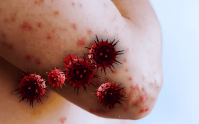 Sarampión en México: ¿Cuándo es más común el contagio y cuáles son los riesgos?