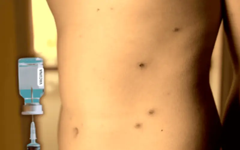 Sarampión en México: ¿El movimiento antivacunas impulsa el resurgimiento de la enfermedad?