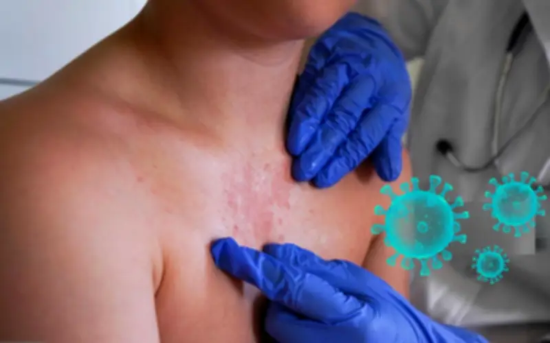 Sarampión en México: El periodo de incubación y el aumento de casos que preocupa a la salud pública