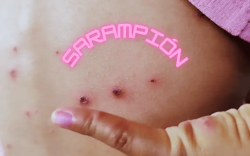 Sarampión en México: experto revela que baja vacunación es la causa del brote