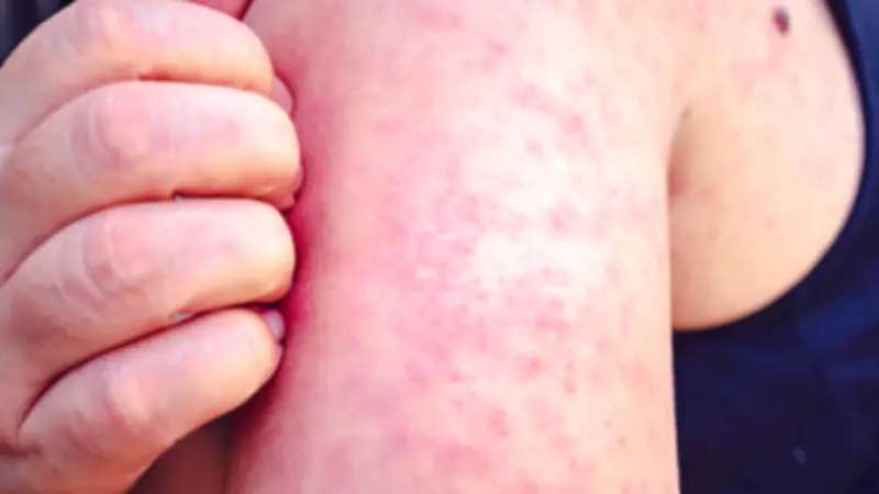 Sarampión en México: La epidemia que no cede por baja cobertura de vacunación histórica