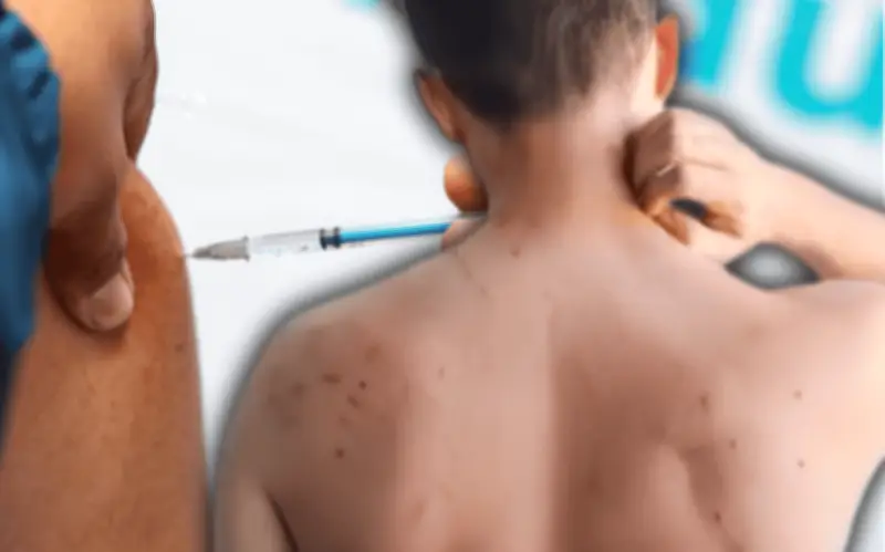 Sarampión en México: Remedios para aliviar síntomas ante repunte de casos