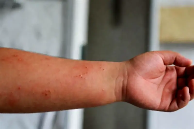 Sarampión en México: Se Elevan a 32 los Fallecimientos Confirmados por el Brote