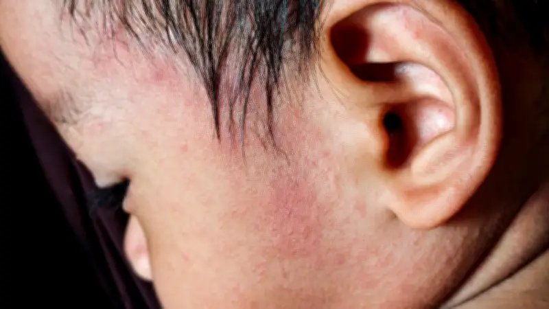 Sarampión en México: Secuelas graves como daño cerebral y sordera permanente alertan a expertos