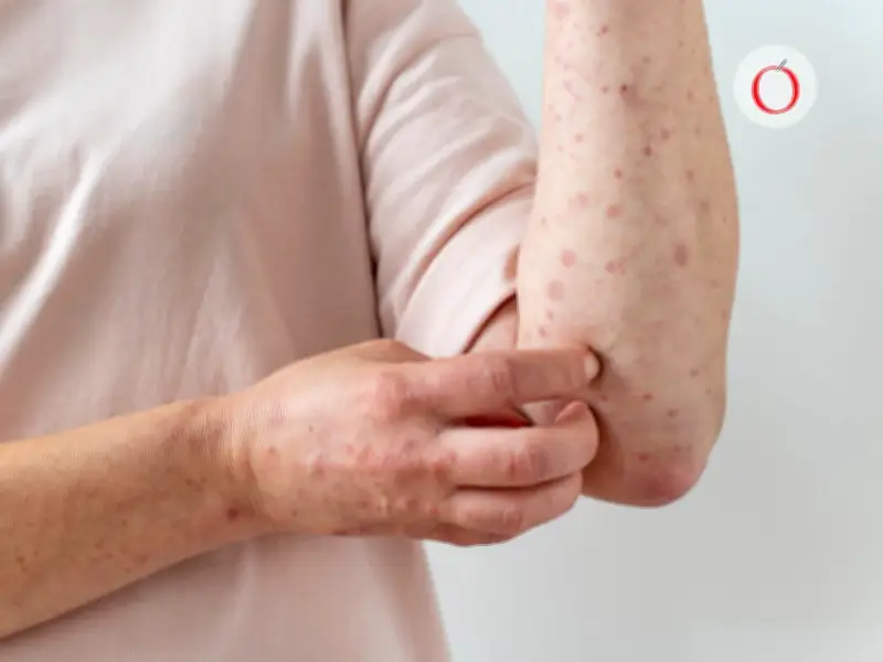 Sarampión en México: Síntomas que se confunden con gripe y cuándo buscar atención médica