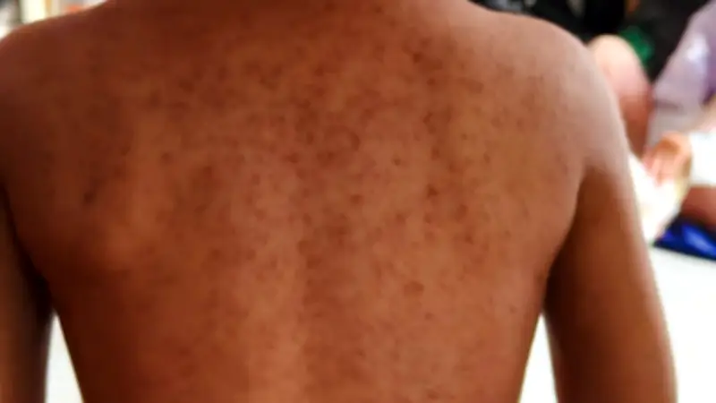 Sarampión en México: Un año de brote con 28 muertes y alerta por Mundial