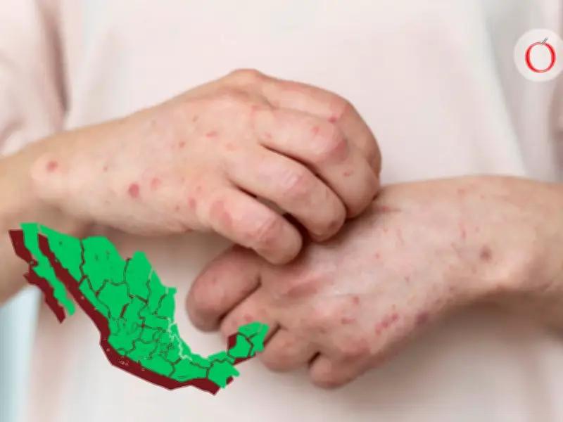 Sarampión resurge en México tras caída del 70% en gasto de vacunas