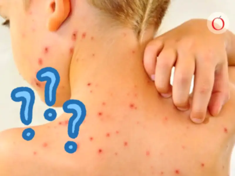 Sarampión, varicela y viruela: diferencias clave en síntomas y prevención