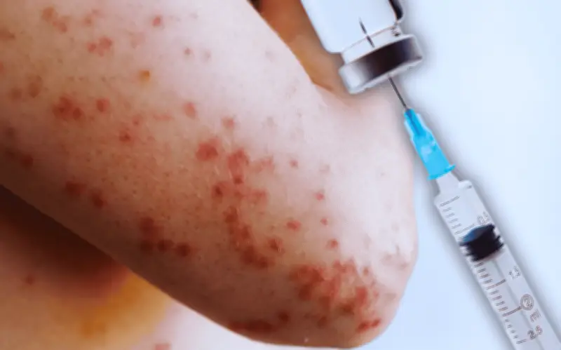 Sarampión en México: ¿Los adultos vacunados en la infancia necesitan revacunarse?