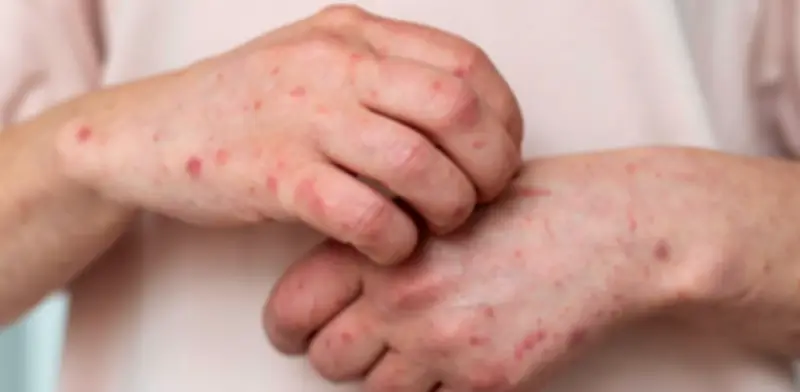 Sarampión en Sinaloa: Dos pacientes hospitalizados y más de 100 contagios en 2026