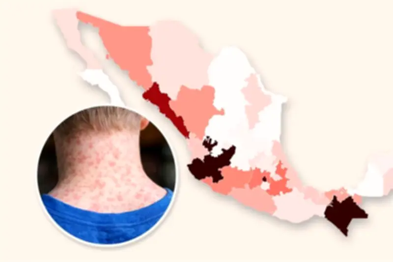 Situación actual del sarampión en México: casos por estado y alerta sanitaria