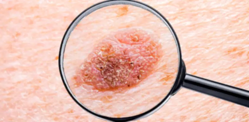 Una de cada cinco personas desarrollará cáncer de piel en su vida, alertan especialistas