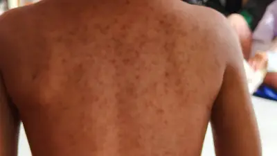 CDMX reporta alcaldías con mayor incidencia de sarampión y pide evitar estigmatización