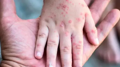 Sarampión en México: 29 muertes acumuladas y brote activo en 32 estados