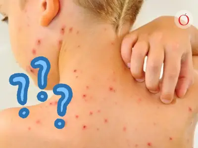 Sarampión, varicela y viruela: diferencias clave en síntomas y prevención