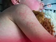 Sarampión: El síntoma clave que aparece antes del sarpullido y cómo diferenciarlo