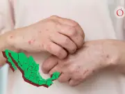 Sarampión en México: 7 estados concentran el 85% de los casos en 2026