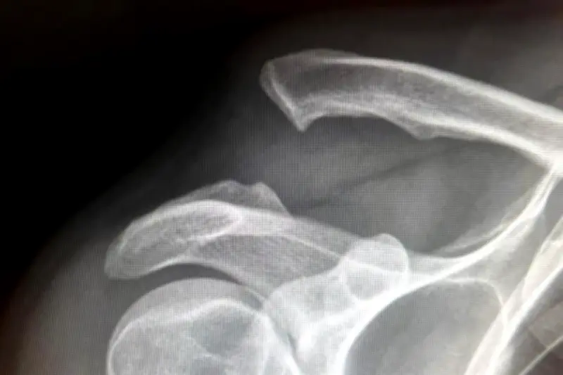 Alcalde de Santiago, Nuevo León, sufre accidente vehicular en zona serrana