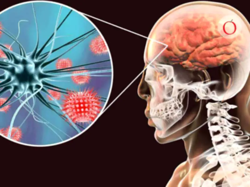 Brote de meningitis en Kent, Reino Unido, dispara alerta sanitaria tras muertes