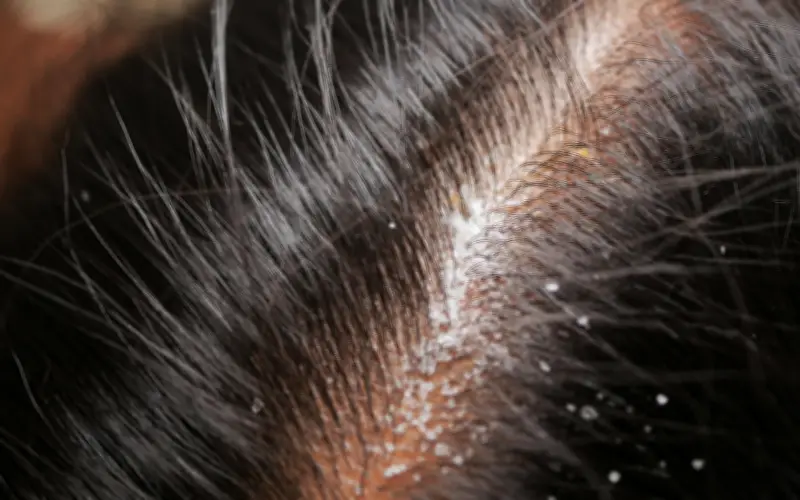 Caspa: causas, síntomas y el tratamiento definitivo para controlarla