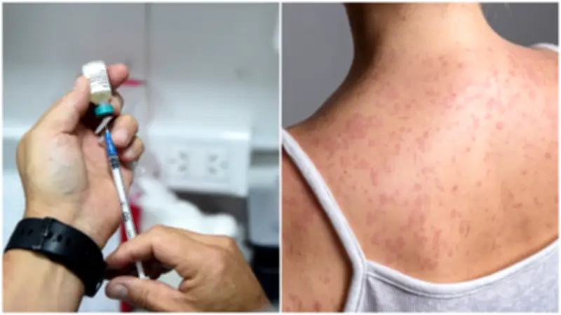 CDMX investiga dos muertes por sarampión y reporta 418 casos confirmados por alcaldía