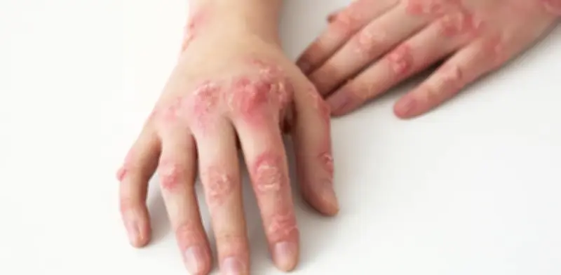 CDMX investiga tercera muerte posible por sarampión; confirman 418 casos