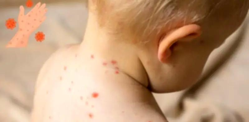 Confirman segunda muerte por sarampión en CDMX; bebé de 7 meses sin vacunar