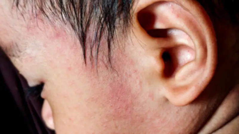 Confirman segunda muerte por sarampión en CDMX: víctima es una niña de siete meses sin vacunar