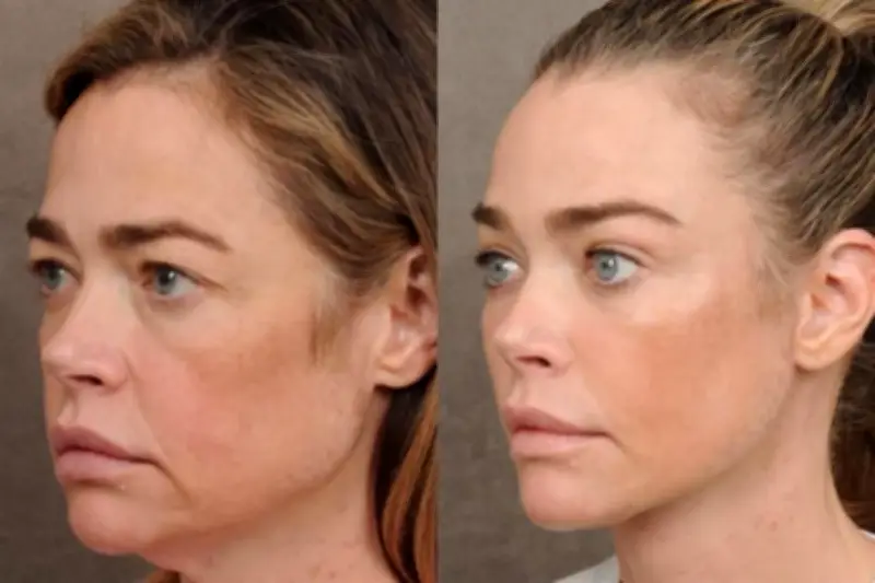 Denise Richards sorprende al revelar su procedimiento de estiramiento facial