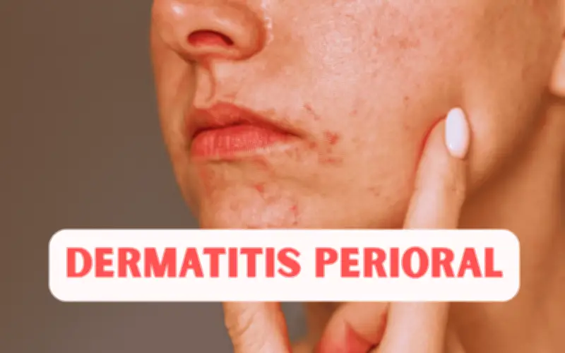 Dermatitis Perioral: ¿Qué son esos granitos alrededor de tu boca?