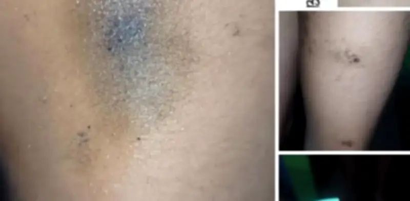 Derrame de Hidrocarburo en Veracruz Causa Graves Lesiones Cutáneas a Bañistas