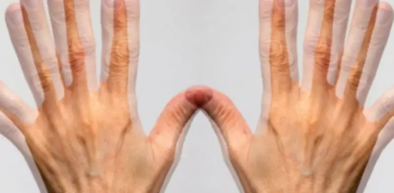 Diplopía: Más Allá del Cansancio, una Señal de Alerta Ocular y Neurológica